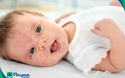 Hard Water and Infant Eczema: How Soft Water Protects Your Baby’s Sensitive Skin in California’s Wine Country